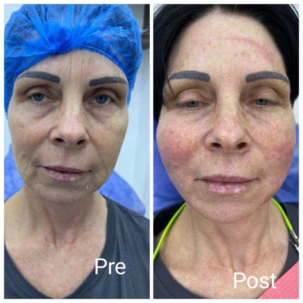 شد وملئ وتكبير الخدود